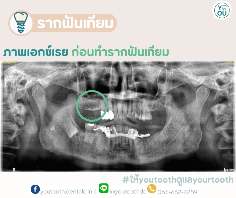 รีวิวรากฟันเทียม