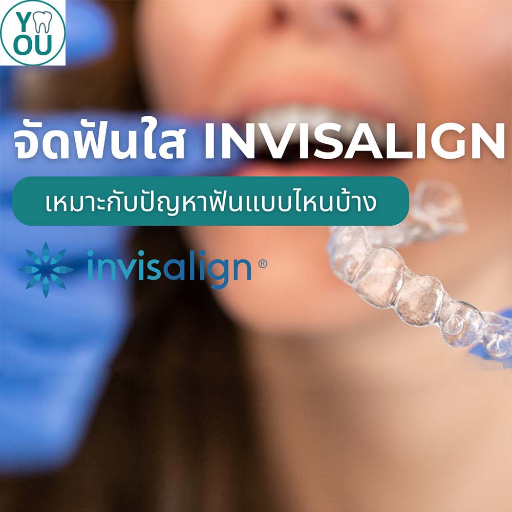 จัดฟันใส Invisalign เหมาะกับปัญหาฟันแบบไหนบ้าง ใช้เวลานานไหม