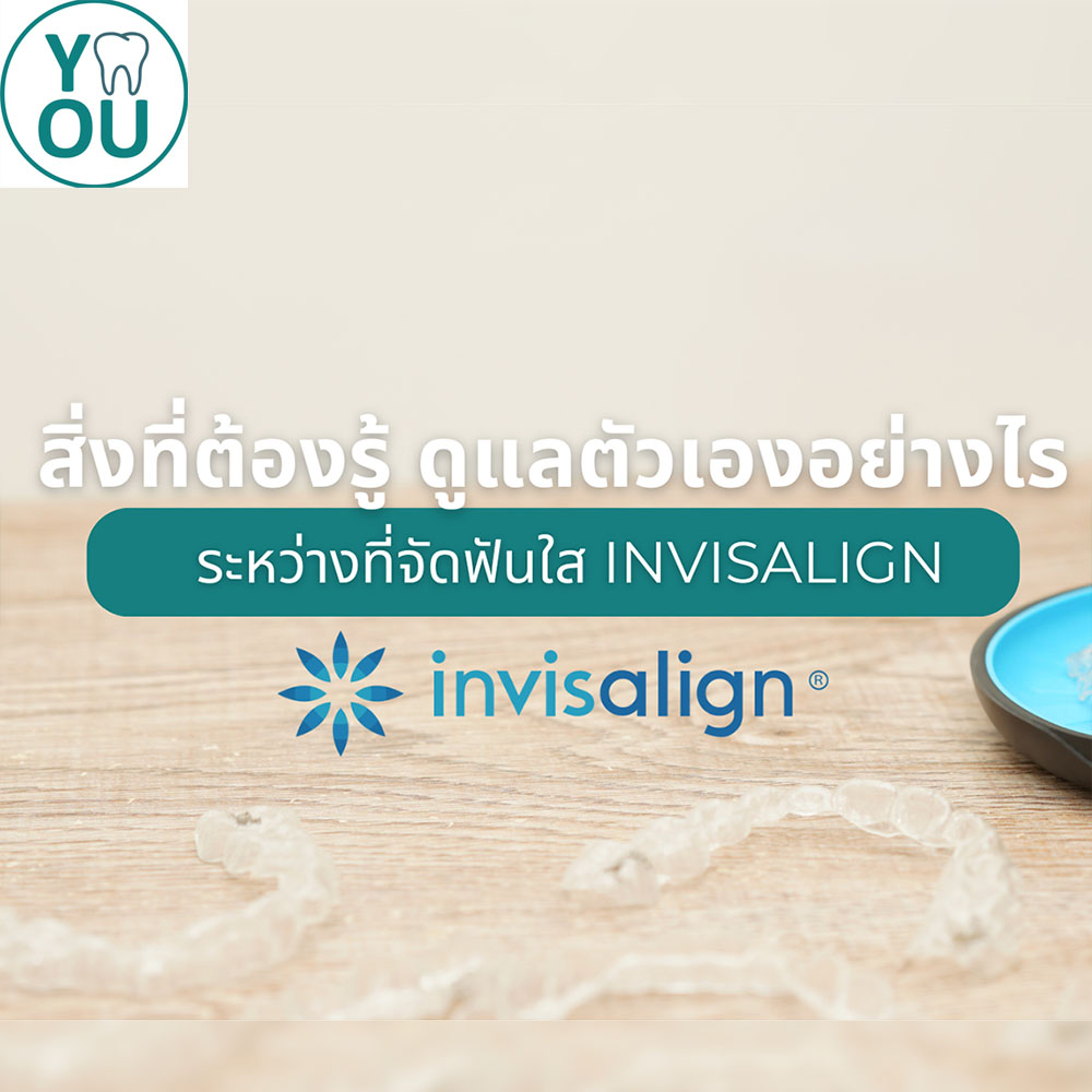 สิ่งที่ต้องรู้ ดูแลตัวเองอย่างไรระหว่างที่จัดฟันใส Invisalign